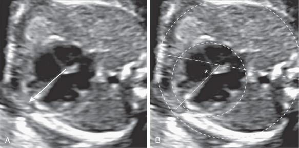 Fig. 74.6, (A) Four-chamber view of the same fetus as in Fig. 76.5 shows that two-thirds of the heart is on the left and the heart axis is pointing to the left. The transverse view of the thorax is correctly magnified and shows only one rib. (B) Normal heart axis (asterisk) and size are also shown.