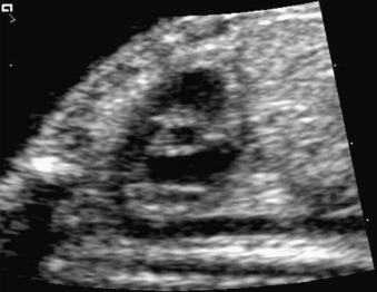 Fig. 74.2, Long-axis view of the right ventricle. The pulmonary artery arises from the right ventricle. The ductal arch has a perpendicular shape resembling a hockey stick.