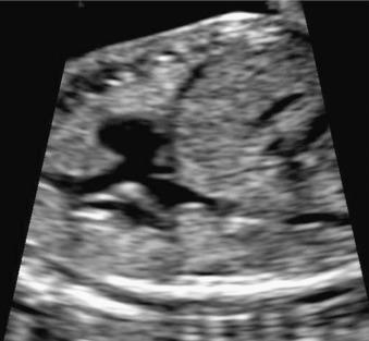 Fig. 74.3, Longitudinal view on the right side of the fetus shows the drainage of the superior vena cava and inferior vena cava to the right atrium.