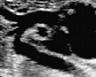 Fig. 74.4, Aortic arch view. Note the presence of the three vessels to the head and the upper limbs and the right pulmonary artery, which can be recognized under the aortic arch in the cross section.