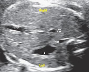 Fig. 74.5, Upper abdomen in a fetus in cephalic presentation. The stomach and descending aorta are correctly located on the left side of the fetus, and the inferior vena cava and the liver are on the right side. Ao, Aorta; IVC, inferior vena cava; S, stomach; UV, umbilical vein.