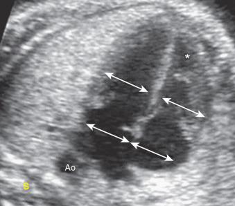 Fig. 74.7, Normal apical four-chamber view shows symmetric atria and ventricles (asterisk) . The moderator band is correctly visible in the anterior ventricle corresponding to the right ventricle. Ao, Aorta; S, stomach.