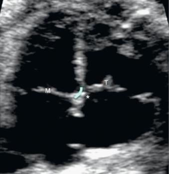 Fig. 74.8, Apical four-chamber view in which the atrioventricular septum is clearly visible between the right atrium and the left ventricle, which indicates correct implantation of the mitral and tricuspid valves. M, Mitral valve; T, tricuspid valve.