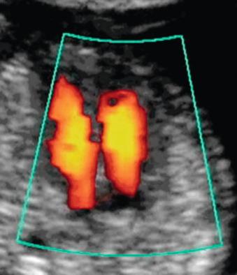 Fig. 74.9, Color Doppler confirmation of normal diastolic flow across both atrioventricular valves.