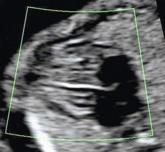 Fig. 74.10, Transverse four-chamber view shows a normal interventricular septum. Color Doppler shows the absence of flow across the interventricular septum.