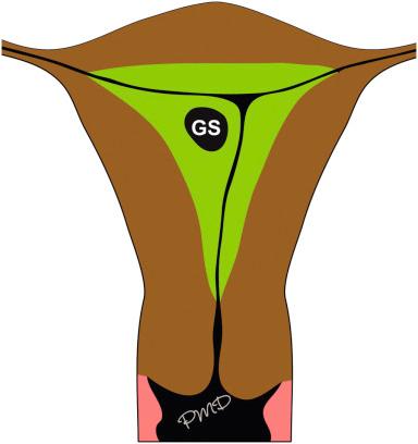 FIG 4-1, Diagram of the early gestational sac (GS) at approximately 5.0 weeks of gestation. The sac is implanted within the decidua (depicted in green ). The uterine cavity ( thin black lines ) is collapsed.