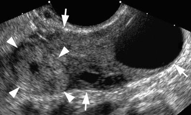 FIG 4-11, Movement with transducer pressure distinguishing ectopic pregnancy from corpus luteum. Note the structure with an echogenic rim and anechoic center ( arrowheads ) lying in or adjacent to the ovary ( arrows ). When pressure was applied with the transvaginal ultrasound transducer, the structure was seen to move separately from the ovary, confirming it as being extraovarian and thus representing an ectopic pregnancy. ( Video 4-2 shows the movement when transducer pressure is applied.)