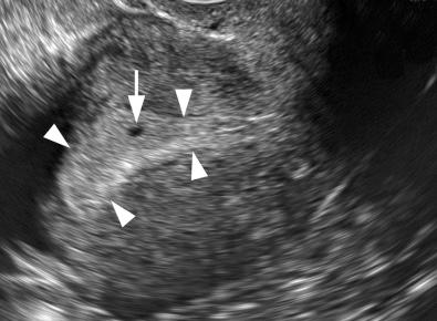 FIG 4-3, 5.0-week pregnancy. The gestational sac ( arrow ), with no identifiable internal structures, lies within the decidua ( arrowheads ).