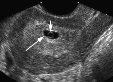 FIG 4-4, 5.5-week pregnancy. The gestational sac ( long arrow ) contains a yolk sac ( short arrow ). No embryo is seen.