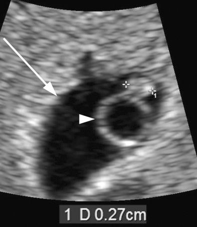 FIG 4-5, 6.0-week pregnancy. The gestational sac ( arrow ) contains an embryo ( calipers ) lying beside the yolk sac ( arrowhead ). The embryo is 2.7 mm in length, and a heartbeat was perceived within it on real-time sonography. (See Video 4-1 , which shows the heartbeat.)