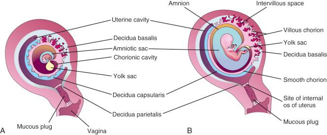 FIG 4-6, A, At 7 weeks' gestational age, chorionic villi completely surround the gestational sac and are relatively thick where they contact underlying endometrial tissue (decidua basalis). As the sac enlarges, the chorion and overlying decidual tissue (decidua capsularis) protrude into the compressed uterine cavity and come into contact with the decidua parietalis. This anatomic configuration gives rise to the double decidual sac sign. B, The compressed and avascular chorionic tissue becomes smooth and is defined by sonologists as the chorionic “membrane.” Because of its fixed anatomic relationship to the developing placenta, in the event of placental bleeding, blood can dissect between the chorionic membrane and overlying decidual tissue, giving rise to a subchorionic hematoma.