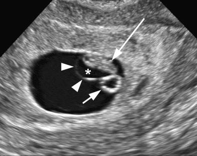 FIG 4-7, 7.0-week pregnancy. The embryo ( long arrow ) is surrounded by a thin membrane, the amnion ( arrowheads ), adjacent to the yolk sac ( short arrow ). Fluid (*) is present within the amniotic cavity, separating the amnion from the embryo.