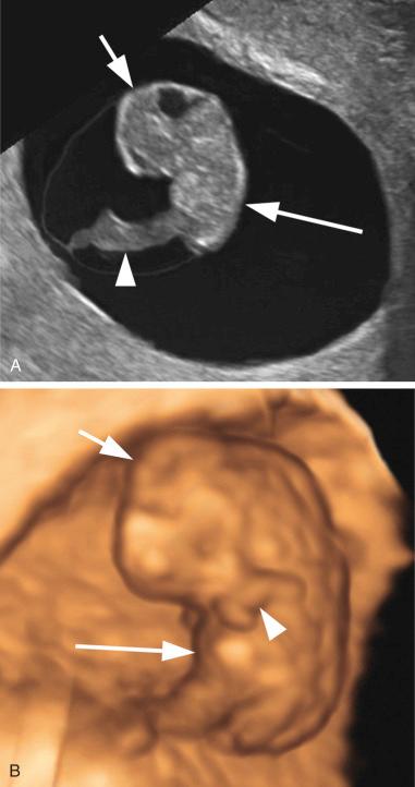 FIG 4-8, 8.0-week pregnancies. A, The head ( short arrow ) and trunk ( long arrow ) are identifiable. The umbilical cord ( arrowhead ) connects to the anterior abdominal wall. B, On a three-dimensional sonogram of another embryo, the head ( short arrow ), trunk ( long arrow ), and an upper extremity ( arrowhead ) are identifiable.