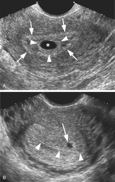 FIG 4-9, Double sac and intradecidual signs. A, The gestational sac (*) is surrounded by an inner echogenic ring ( arrowheads ) and an outer echogenic ring ( arrows ). The presence of two surrounding rings constitutes the double sac sign of early intrauterine pregnancy. B, The gestational sac ( arrow ) is eccentrically located in the echogenic decidua, anterior to a thin white line ( arrowheads ) representing the collapsed uterine cavity. This appearance constitutes the intradecidual sign of early intrauterine pregnancy.