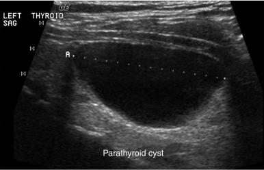 Fig. 13.1, Posterior enhancement deep to a parathyroid cyst.