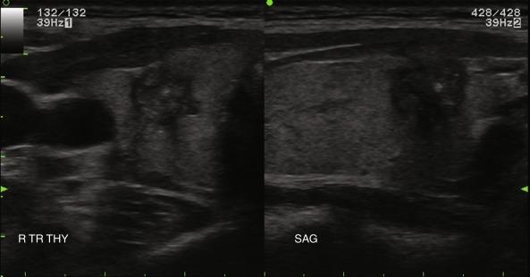 Fig. 13.11, Irregularly shaped nodule with microlobulated borders, confirmed to be a papillary carcinoma.