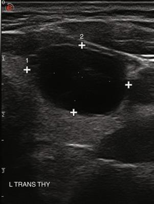 Fig. 13.12, Cystic degeneration of a benign thyroid nodule.