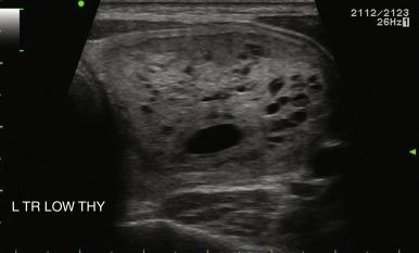 Fig. 13.13, Benign, spongiform thyroid nodule, with multiple microcystic components.