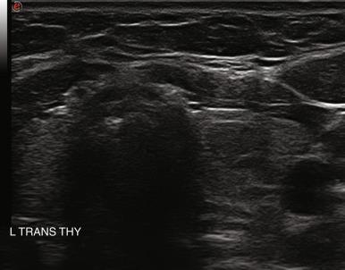 Fig. 13.14, Slightly hypoechoic benign adenomatous nodule.