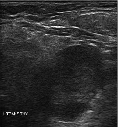 Fig. 13.15, Moderately hypoechoic and elongated nodule that proved to be a follicular carcinoma.