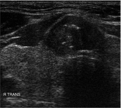 Fig. 13.16, Microcalcifications in a papillary thyroid carcinoma.