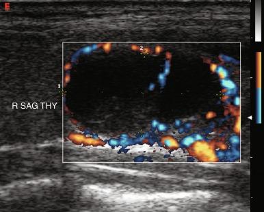 Fig. 13.18, Follicular adenoma with peripheral blood flow.