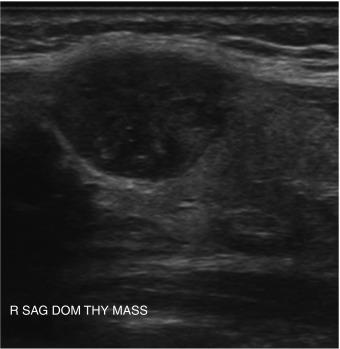 Fig. 13.19, Thyroid nodule with greater than 25% capsular contact, confirmed to be papillary carcinoma with extrathyroidal extension.