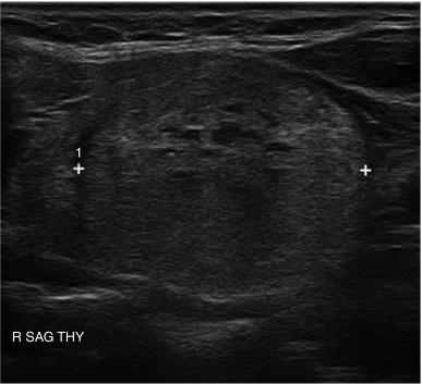 Fig. 13.20, Colloid nodule, right sagittal view.