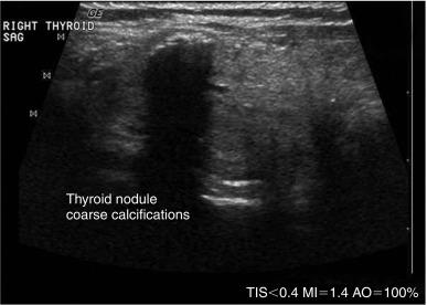 Fig. 13.2, Hyperechoic dense calcification in a thyroid nodule prevents penetration of sound, and a resultant deep shadow is identified.