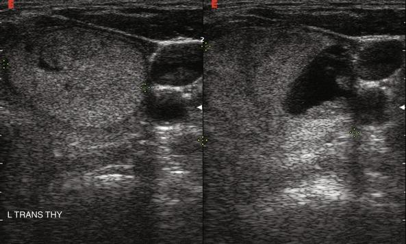 Fig. 13.21, Hemorrhage (right panel) into a follicular adenoma (left transverse view). Note halo surrounding the nodule.