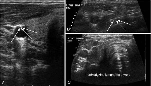 Fig. 13.5, Reverberation artifact can be seen in the following: A, anterior wall of the carotid artery; B, biopsy needles in the long axis; C, anterior tracheal wall. Arrows demonstrate the reverberating artifacts.