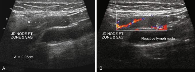 Fig. 13.6, Power Doppler demonstrates small vessels and their pattern in a hyperplastic lymph node ( A, grayscale; B, power Doppler overlay).