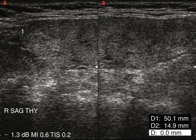 Fig. 13.7, Sagittal view of thyroid lobe with superior and inferior portions spliced together using the split-screen feature.