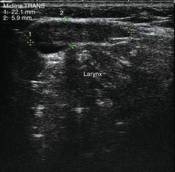 Fig. 13.8, Thyroglossal duct cyst within thyrohyoid space, seen as a well-defined hypoechoic cystic structure overhanging the superior aspect of the larynx (midline transverse view).