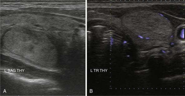 Fig. 13.9, A, Thin hypoechoic circumferential “halo” surrounding a benign thyroid nodule. B,