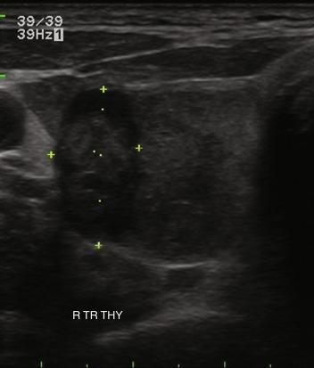 Fig. 13.10, Taller than wide (and markedly hypoechoic) nodule that proved to be malignant on surgical pathology (right transverse view of thyroid).