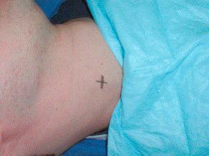 F igure 69-2-3, Subcutaneous location of IJV is marked on the skin surface.