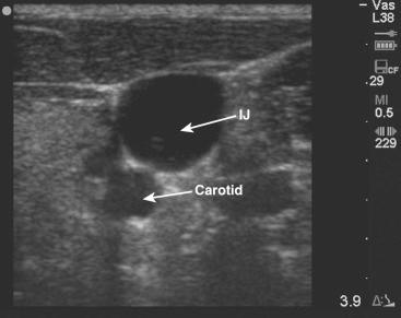F igure 69-1-3, Transverse anatomy of the vessels of the neck.