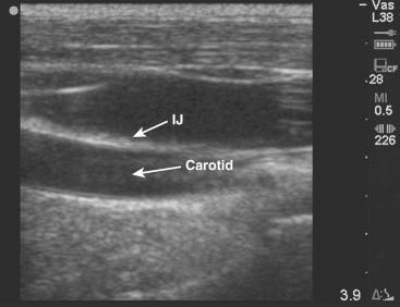 F igure 69-1-6, The internal jugular (IJ) vein and carotid artery in longitudinal orientation.