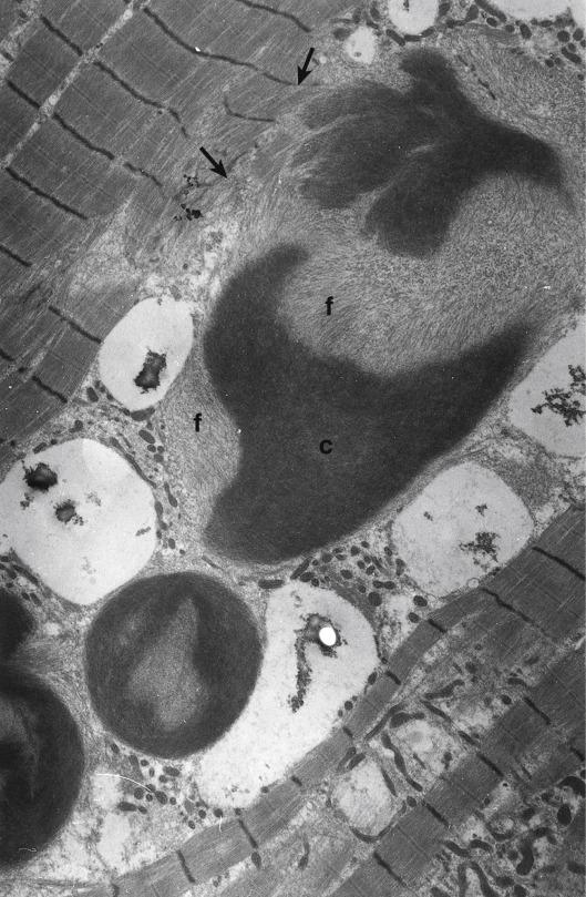 Fig. 5.41, Group of unusual cytoplasmic bodies which show continuity with myofibrils (arrows). The core (c) is irregular in shape and not circular; no halo is present, but filaments (f) radiate from the core. (‘Cytoplasmic body myopathy’.)