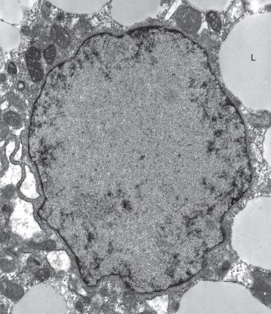 Figure 5.11, Hepatitis B virus (original magnification, ×9100). An infected hepatocyte is seen with numerous intranuclear viral particles and surrounding lipid droplets (L) .