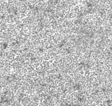 Figure 5.12, Hepatitis B virus (original magnification, ×56,000). Numerous granular viral particles are seen.