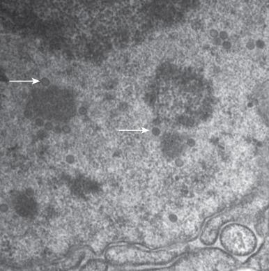 Figure 5.2, Herpesvirus (original magnification, ×28,000). Numerous clusters of intranuclear viral particles (arrows) are seen in a sample from the cerebrum of a patient with herpes simplex encephalitis.