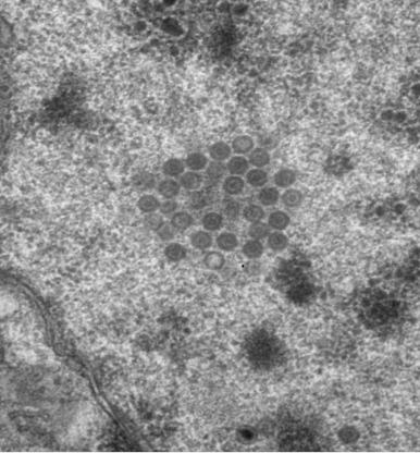 Figure 5.3, Herpesvirus (original magnification, ×44,000). Round to hexagonal or “stop sign”-shaped, targetoid viral particles are seen.