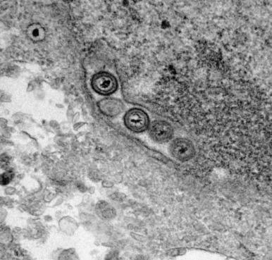 Figure 5.4, Varicella virus (original magnification, ×57,000). Round to hexagonal or “stop sign”-shaped, targetoid viral particles are seen in cell culture.