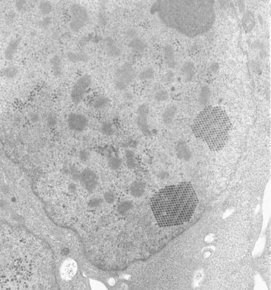 Figure 5.5, Adenovirus (original magnification, ×11,000). Numerous packets of virions in a regular latticelike arrangement are seen in cell culture.