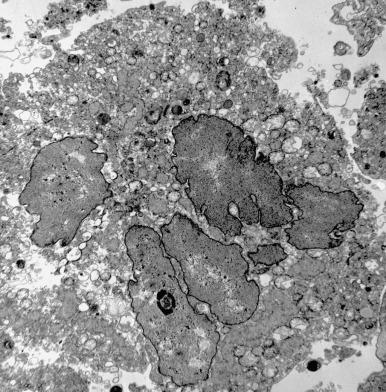 Figure 5.9, Parainfluenza virus (original magnification, ×3400). Multiple nuclei with a ground glass texture are seen in a sample of lung. Measles can have a similar appearance.