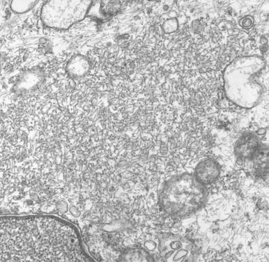 Figure 5.10, Parainfluenza virus (original magnification, ×19,000). Virions are diffusely dispersed in the cytoplasm in a sample of lung. Measles can have a similar appearance.