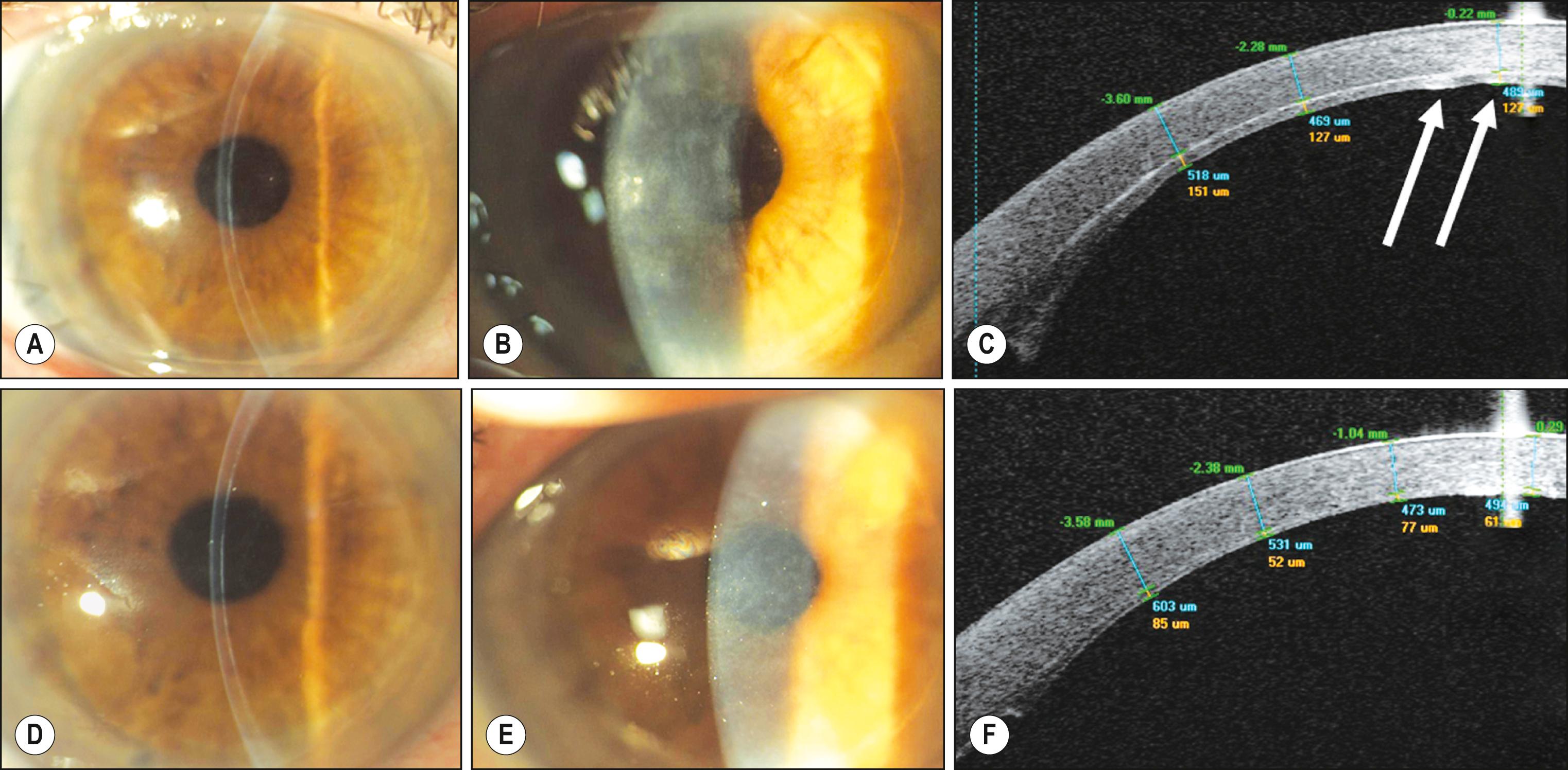 Fig. 131.1, Slit lamp ( A , B ) and anterior segment optical coherence tomography (AS-OCT) ( C ) of a 62-year-old female patient 1 year after Descemet stripping automated endothelial keratoplasty. Vision of 20/60 correlates with the central irregularities of the stromal component of the graft ( C , arrows ). The same patient recovered 20/20 vision 9 months after graft exchange. Slit lamp ( D , E ) and AS-OCT ( F ) show an improved interface with a graft of uniform thickness ranging between 60 and 80 μm.