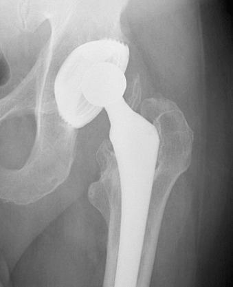 Fig. 64.2, Anteroposterior radiograph of a threaded acetabular cup.